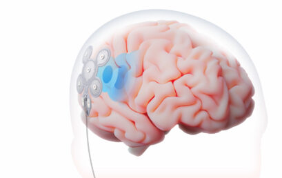 The First Patient Receives Life-Changing Epilepsy Implant To Reduce Seizures